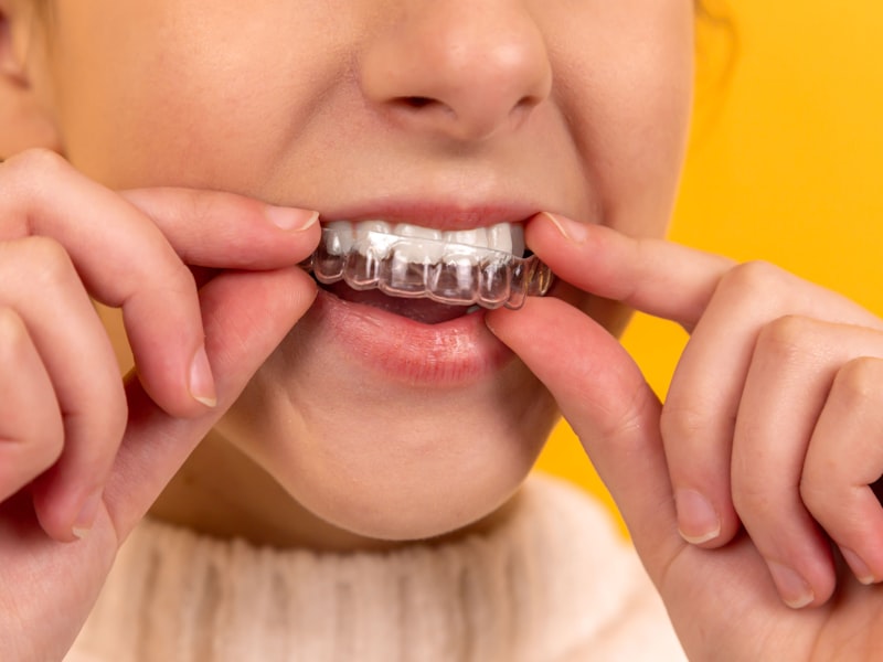 Teeth Alignment